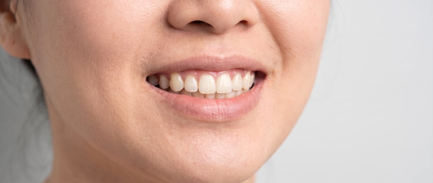 The same smile after treatment: the gap is filled by an implant crown that looks exactly like a natural tooth, matching its neighbours in size and shade, with a healthy gum line around it (sample picture)