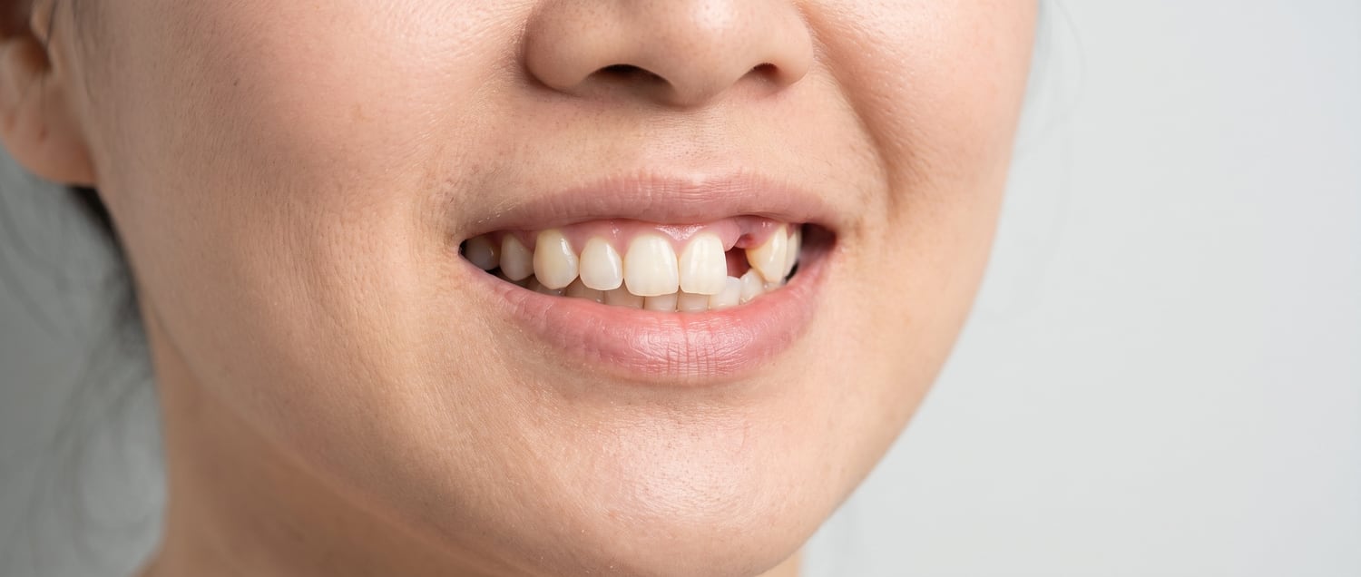 Close-up of a smile before treatment: one upper tooth just beside the front teeth (the lateral incisor) is missing (sample picture)
